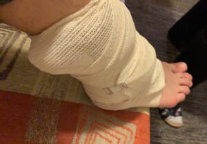 Broken leg